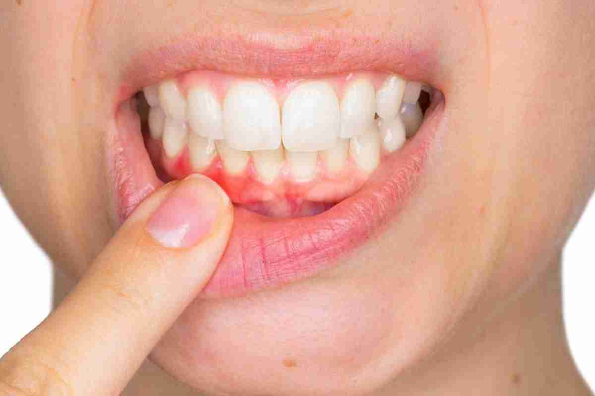 Флюс на десні - небезпечне стоматологічне захворювання