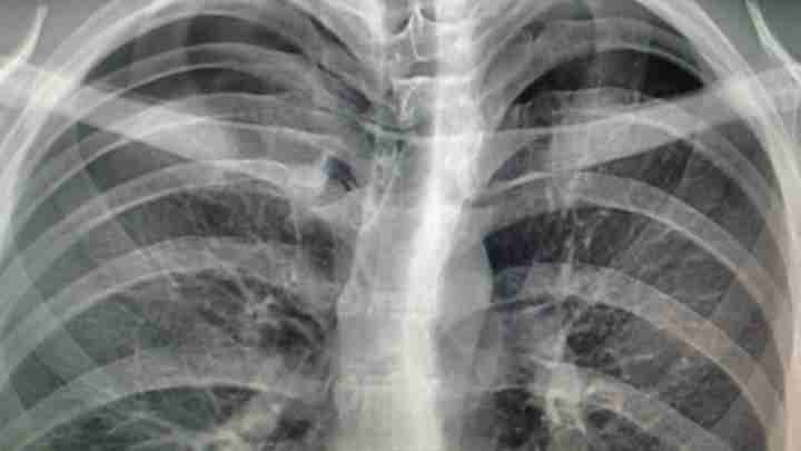 Гідроторакс легені: причини, симптоми і методи лікування