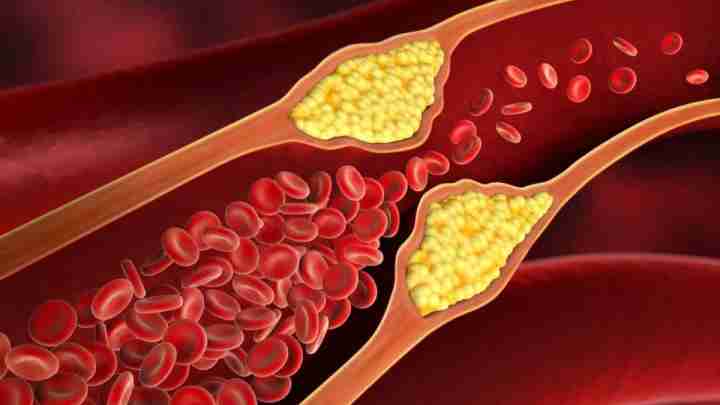 Як знизити холестерин у крові у жінок: народні засоби та лікарські препарати. Чистка організму від шлаків і токсинів