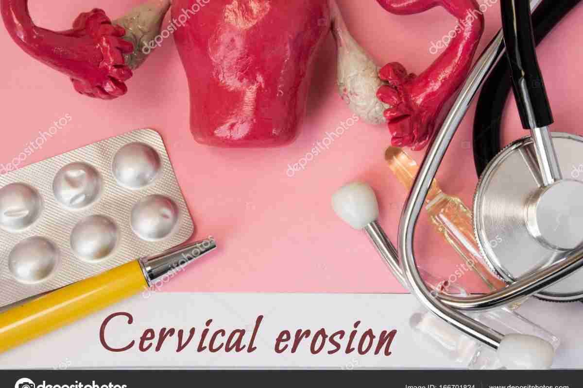 Як лікувати ерозію шийки матки? Способи лікування і наслідки