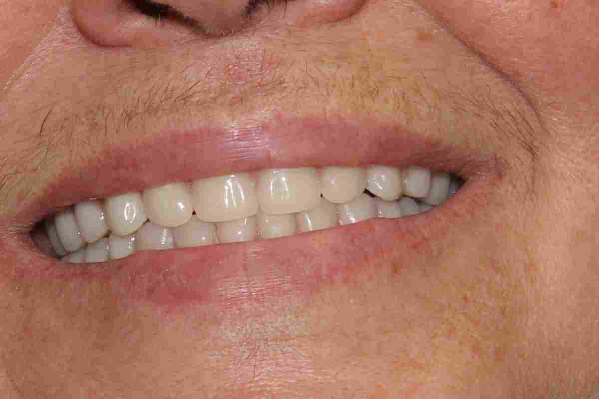 Протезування передніх зубів - мінімум дискомфорту і... бездоганна посмішка