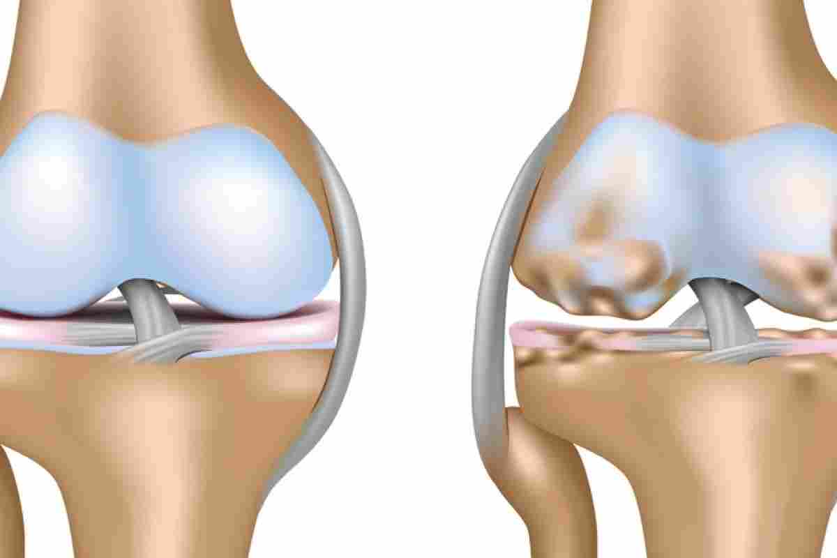 Дієта при артрозі колінних суглобів: рекомендації