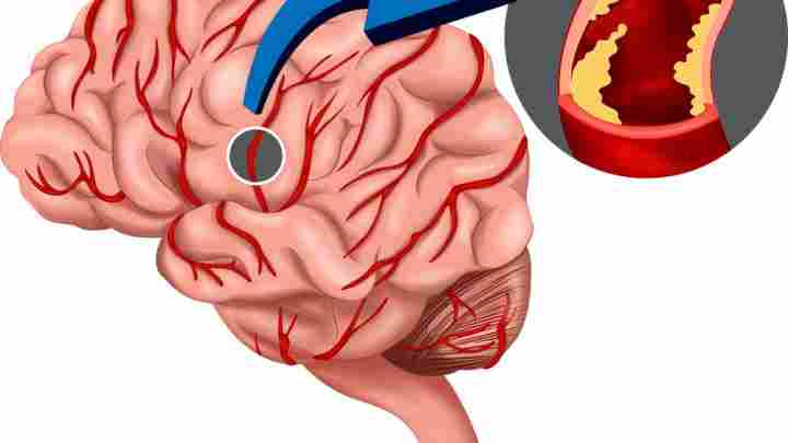 Лікування атеросклерозу судин головного мозку народними засобами та медикаментами