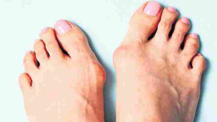 Шишка на нозі біля великого пальця: причини, лікування, операція. Як лікувати шишку на нозі біля великого пальця народними засобами?