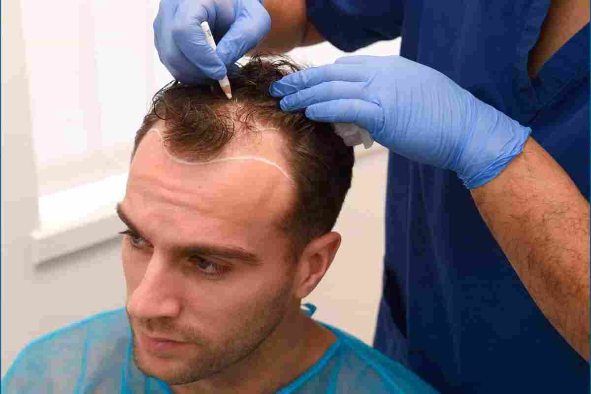 Пересадка волосся на голові і не тільки - все, що ви хотіли знати про цю процедуру