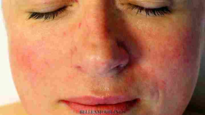 Купероз на обличчі - причини і лікування судинних зірочок