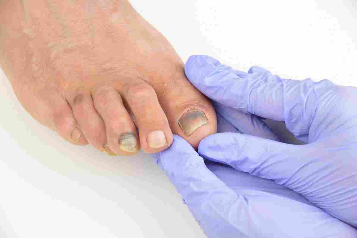 Лікування грибка нігтів - кращі методи усунення онихомикоза