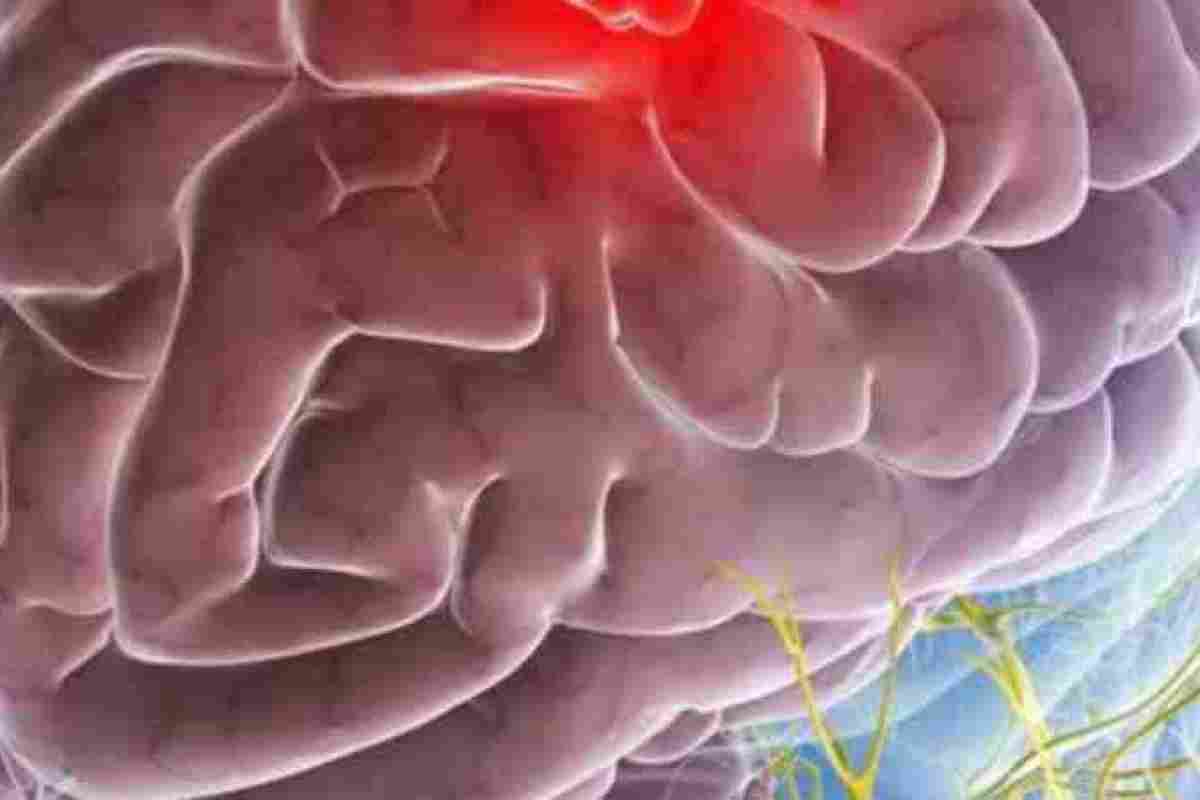 Гліома головного мозку - чим небезпечна пухлина і скільки з нею живуть?