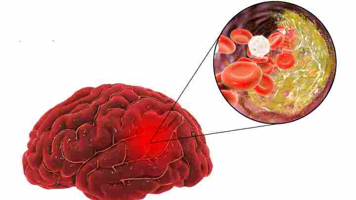 Геморагічний інсульт - як розпізнати крововилив у мозок і що робити?