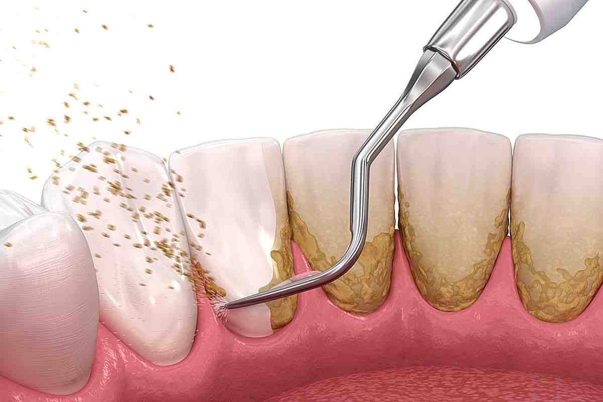 Як вилучити зубний наліт