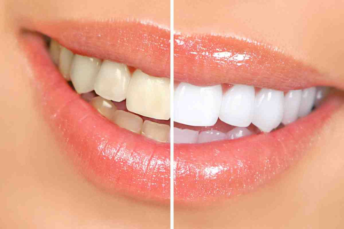 Як вибрати засіб для відбілювання зубів в домашніх умовах